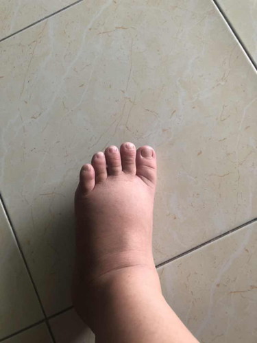 เท้าบวมเเบบนี้ควรไปพบแพทย์ไหมค่ะ