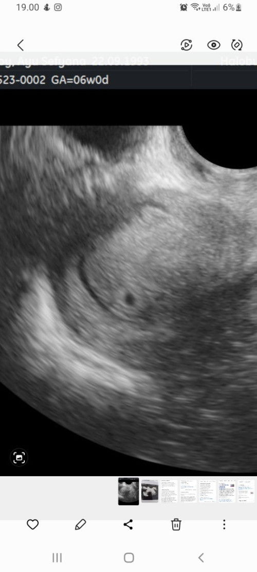 Usg 6w baru kantung kecil, normalkah?