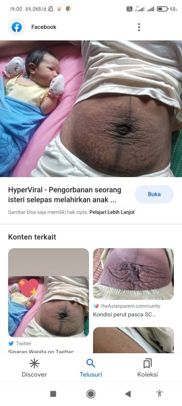 Perut hitam setelah melahirkan