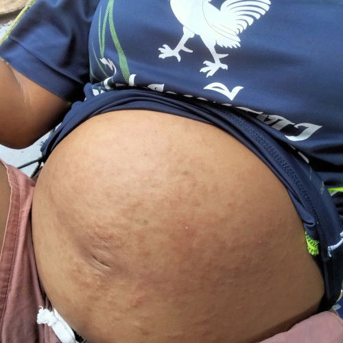 เป็นผื่นคันคะ