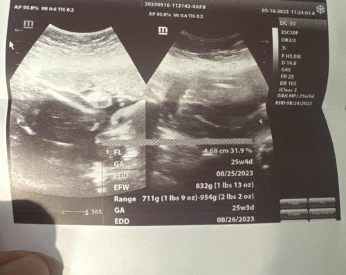 ULTRASOUND RESULT