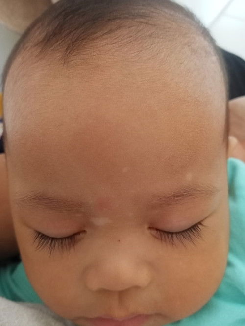 Putih2 di wajah dan leher