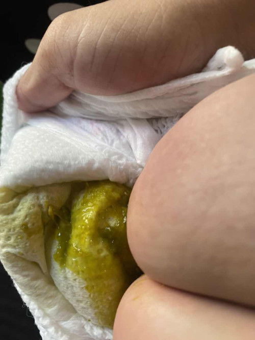 อุจจาระแบบนี้ ผิดปกติไหมคะ