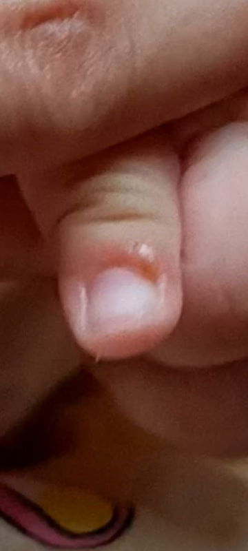 Kuku bayi bengkak dan bernanah