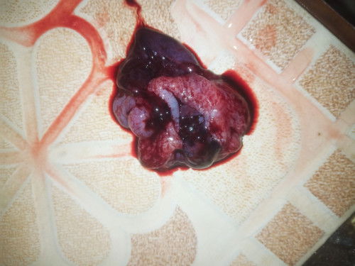 Kehamilan & Keguguran untuk pertama kalinya