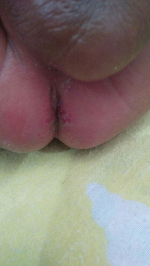 Bayiku umur 1 bulan pantat nya merah2 bunda2 cantik kira2 pake apa yah?