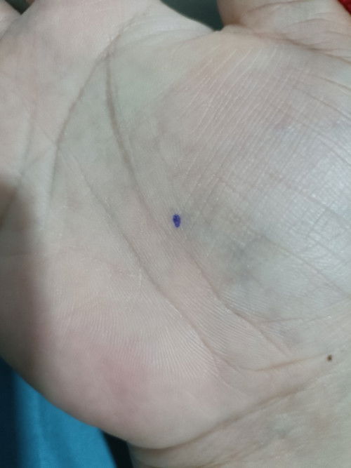 จุดขาวๆที่เหงือกใช่ฟันมั้ย