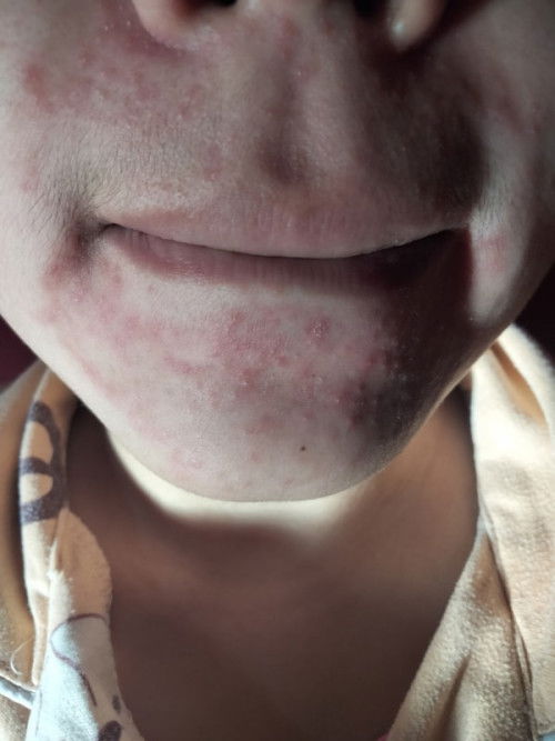 Obat Jerawat kecil2 dan banyak