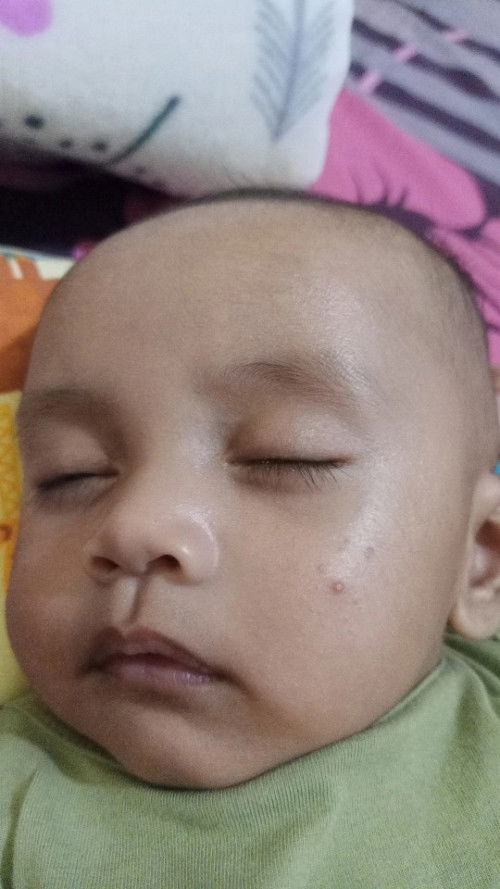 Bentol bentol pada Pipi bayik