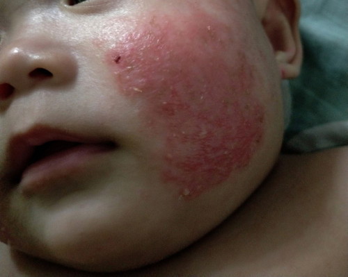 Eczema baby 4 bulan lebih