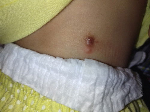 ask ko lng mga mi ano po kaya itong nasa likod ng baby ko salamat po