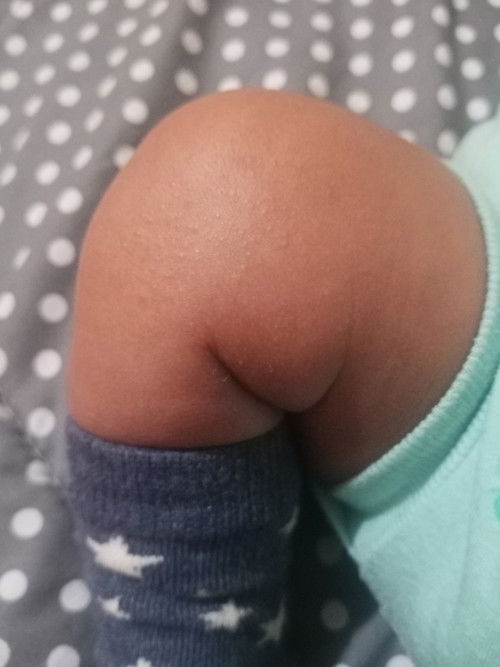 Kaki muncul bruntusan