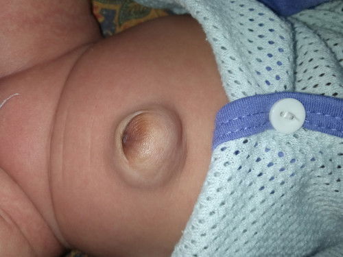 Pusat baby mcm bengkak