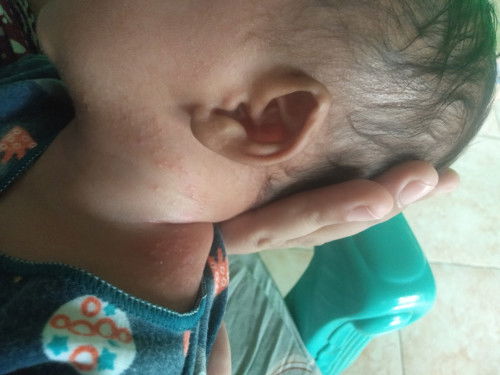 Ruam dilehen dan punggung