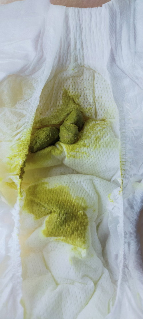 Bayi 38 hari buang air besar najis berketul