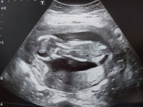 คลอดลูกตอนอายุครรภ์4เดือน