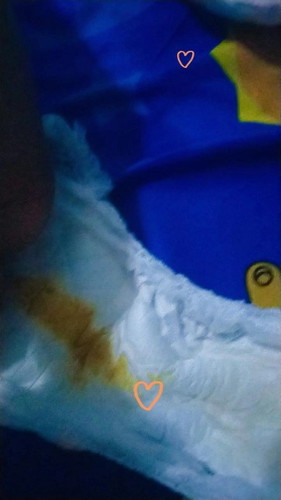Bayi umur 6 bulan . Apakah normal bab nya hmpir tiap hari tpi wrna oren Bun. Kadang dikit kdang bny