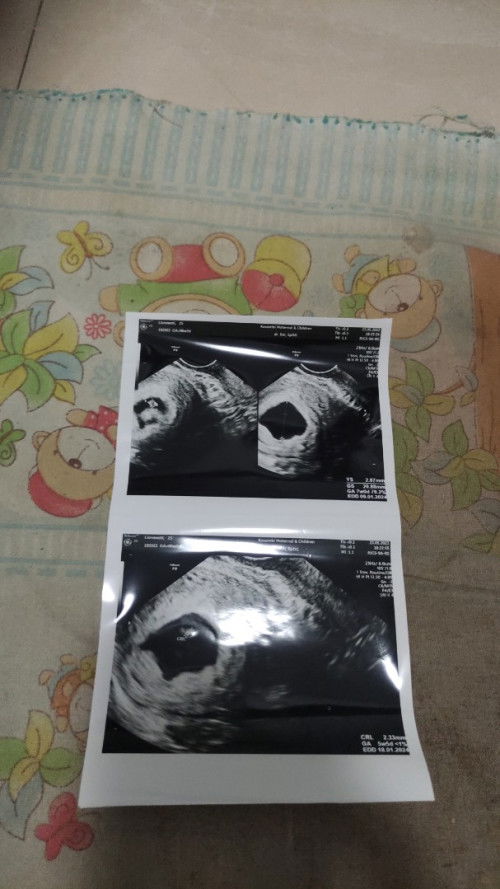 Hasil USG masih terlihat kecil