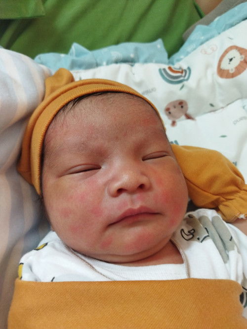 Kulit anak merah merah seperti alergi