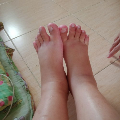 ทำงานแล้วเท้าบวม