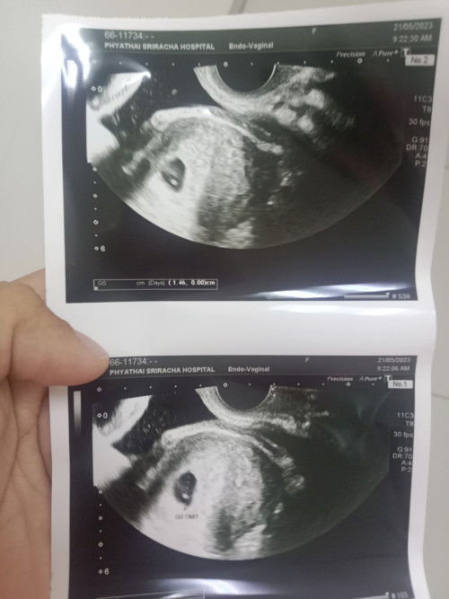 มีโอกาสท้องลมไหมค่ะ