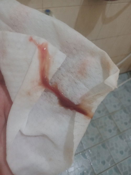 ใช่มูกเลือดมั้ยคะควรไปหาหมอเลยมั้ยคะตอนนี้ได้38+1 พึ่งโดนหมอกระตุ้นไปเมื่อเช้าพอกลางคืนก็มีมูกเเบบนี