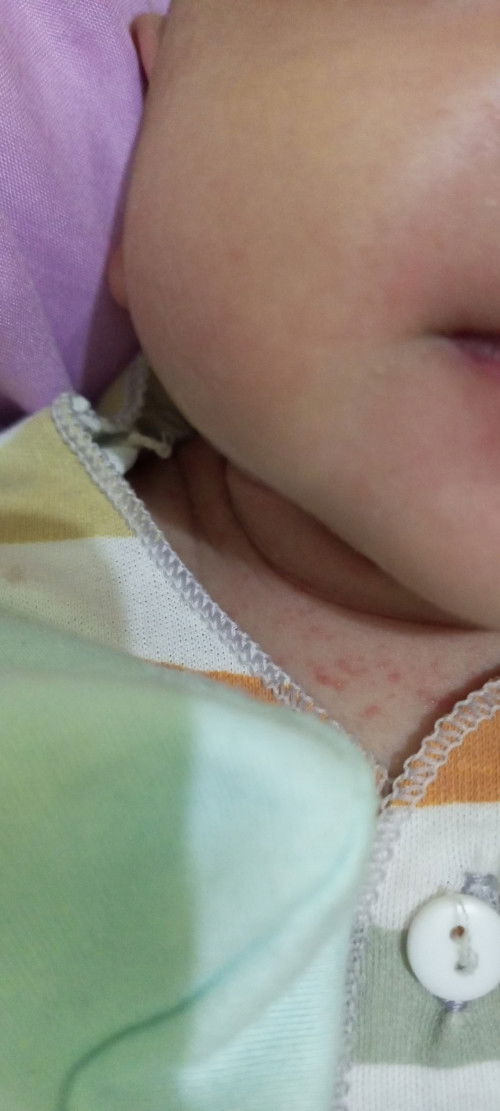 Bercak merah di kulit