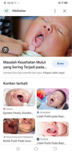 Bund anaknya ada yang gusinya putih gak yahh kaya bintik putih gitu di gusi bukan dilidah,