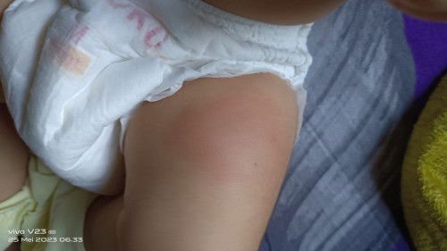 Bengkak setelah imunisasi di paha