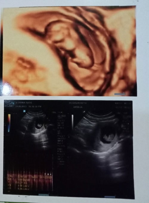 Janin menempel di samping kanan rahim