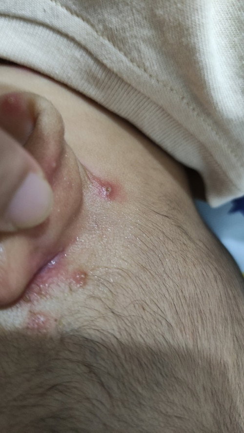 Bentol di telinga anak