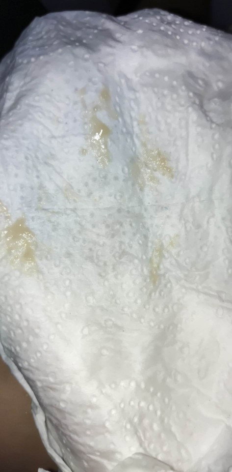 Yellowish Discharge at 15th week