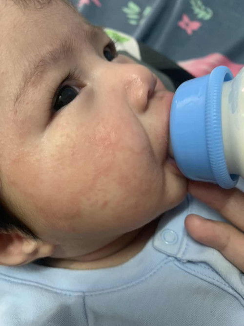 ผิวแพ้ง่าย ทารกวัย2เดือน