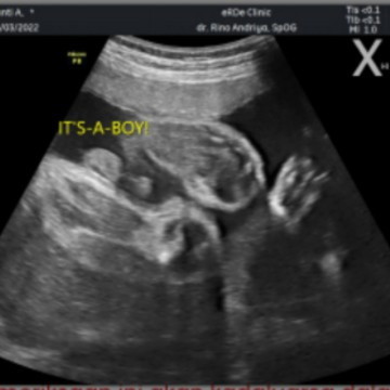 USG JK it's a boy