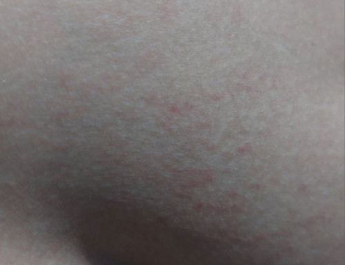 Gatel diperut, leher, dan PD