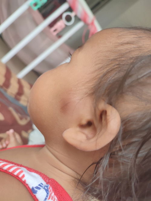 ตุ่มไม่แน่ใจช่ายสิวไหม