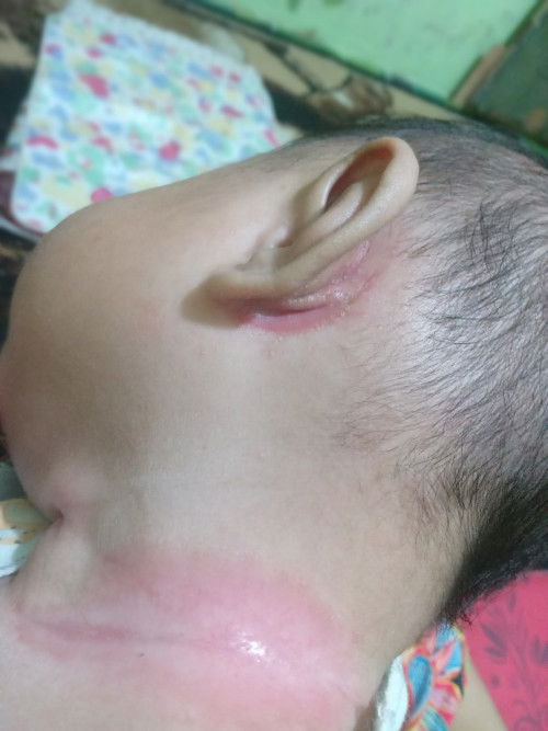 Leher dan telinga sebelah kiri merah merah