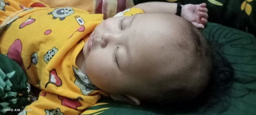 Dikepala anak sya ada garis melengkung bun, usianya sekarang 6 bulan, apakah ini normal bun ???