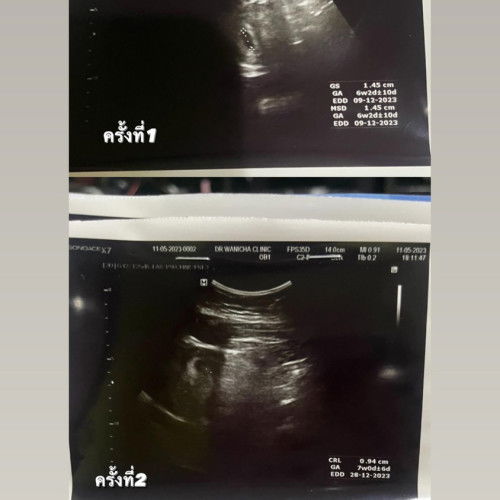 แม่ๆช่วยอ่านค่าอัลตร้าซาวด์ให้หน่อยค่ะ