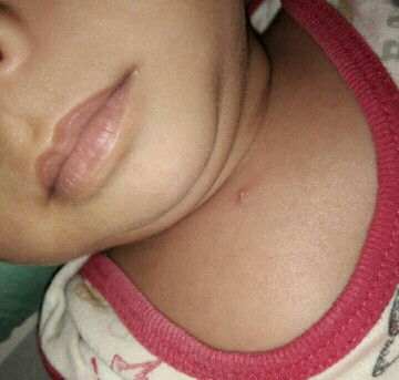 help baby ada jerawat