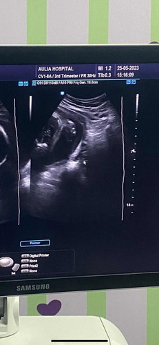 flek usia kehamilan 24weeks