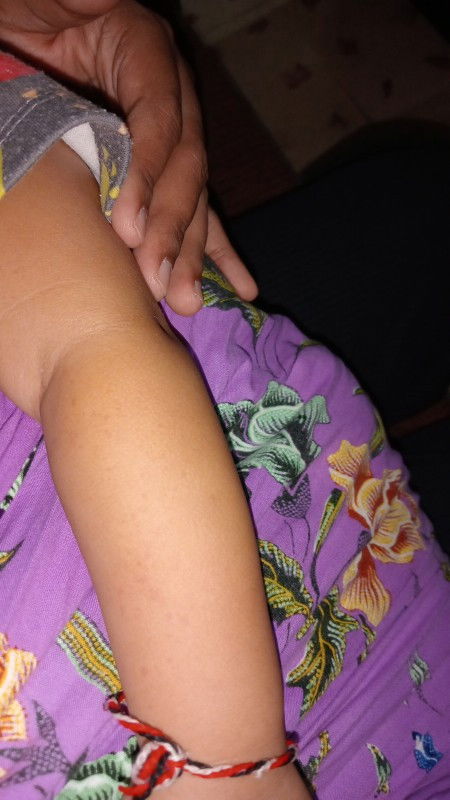 Bintik merah dilengan