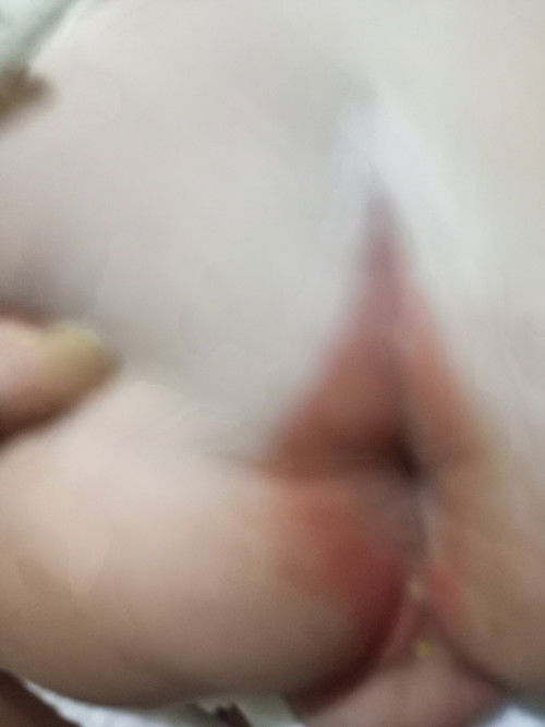 Merah dibagian belahan pantat