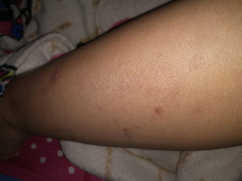 Gatal2 habis lahiran normal