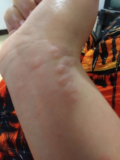 Masuk 5 bulan ko badan pada gatel bentol ya