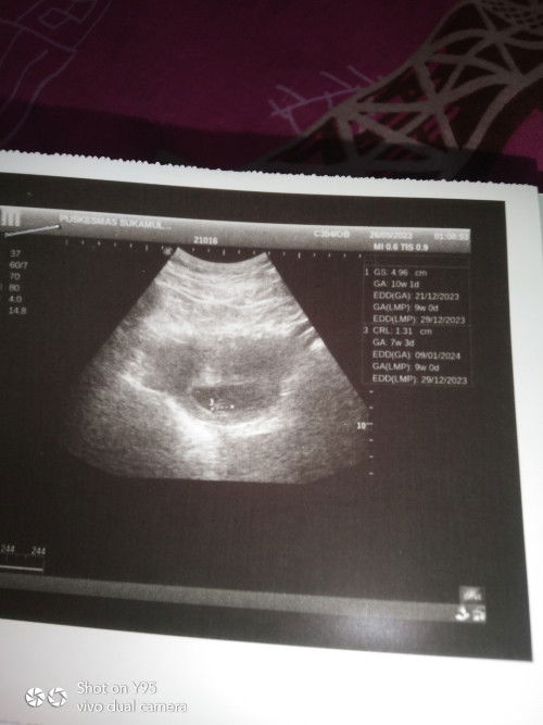 Usia Ukuran kantong dan usia janin tak sesuai