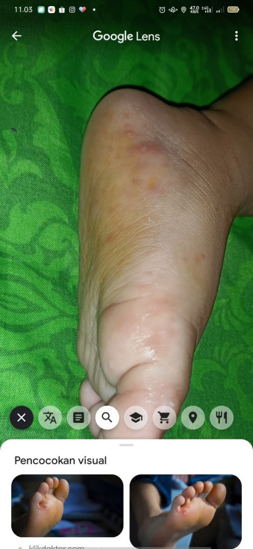 Bund mungkin ada yang pernah mengalami, bisa spill obat & tips nya bun🙏