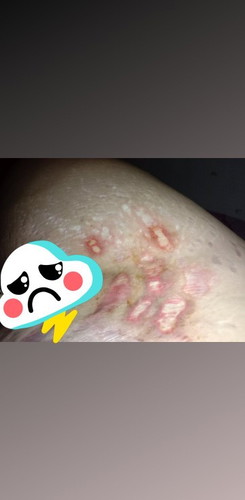 Hi po mga mami ano po pwede igamot sa case ng strechmark ko? im 26pregnant and nagsusugat po siya😢