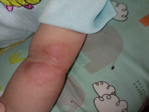 Tanya seputar kulit anak