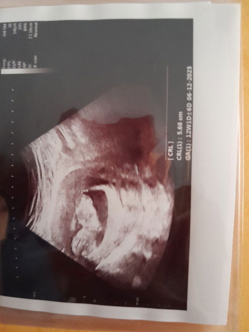 Diagnosa placenta ngelupas usia 3bulan